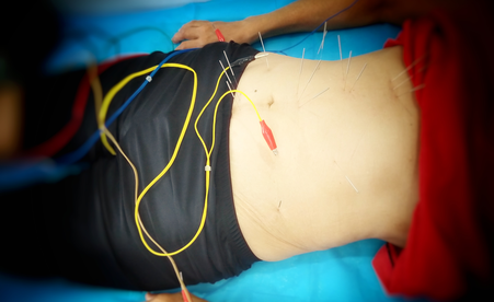 afvallen met acupunctuur geïllustreerd door een electro acupunctuur setting op de buik
